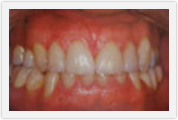 boca raton dental crowns