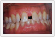 dental crowns boca raton