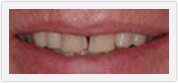 porcelain crowns boca raton fl