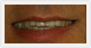 boca raton dental bridges