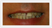 dental bridges boca raton fl