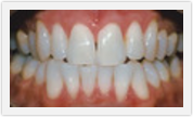 boca raton teeth whitening