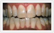 teeth whitening boca raton fl