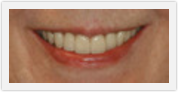 boca raton fl veneers