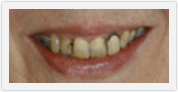 dental veneers boca raton fl