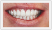 boca raton veneers teeth whitening