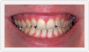 veneers whitening boca raton fl