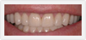 boca raton porcelain crowns